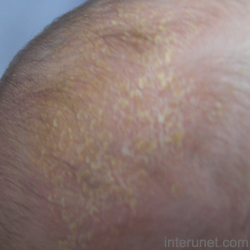 cradle-cap-skin-rash